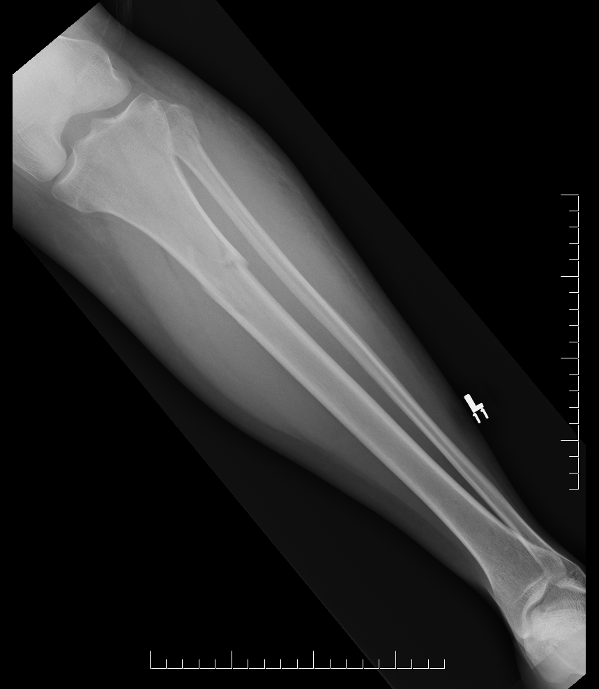 Proximal Tibial Fracture 1